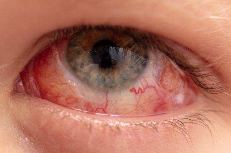 Retinal Detachment Repair--------19