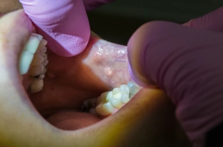 Salivary gland disorder treatments-------19