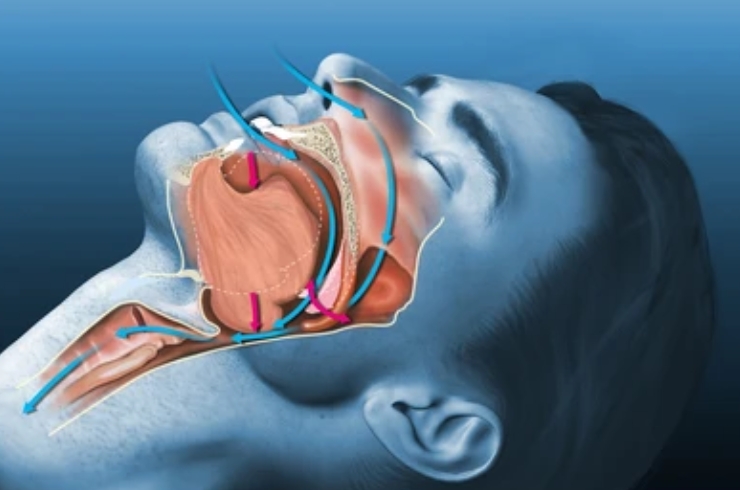 Sleep Apnea