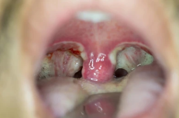 Tonsil & Adenoid Surgery-------19