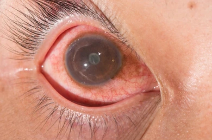 Uveitis Treatment------19