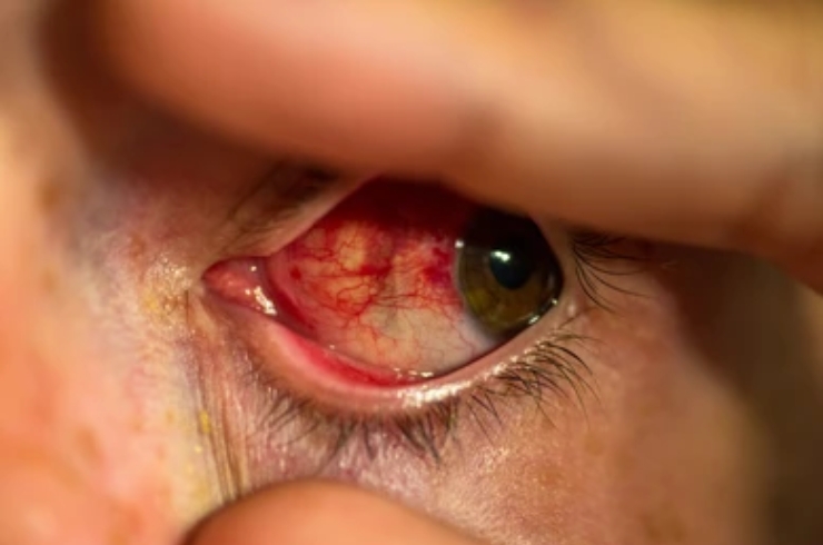 corneal Transplants--------19
